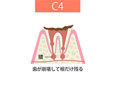 C4【歯根まで達したむし歯】