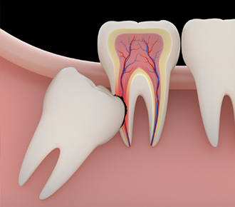 親知らずの処置について