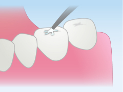 シーラント~むし歯になりやすい奥歯もしっかり予防~