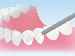 フッ素塗布~むし歯になりにくい強い歯にするために~