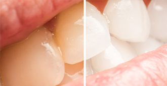 ホームホワイトニング