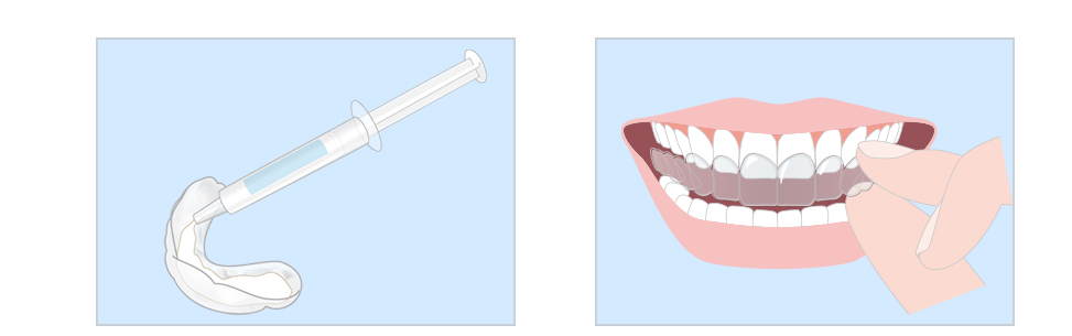 ホームホワイトニング