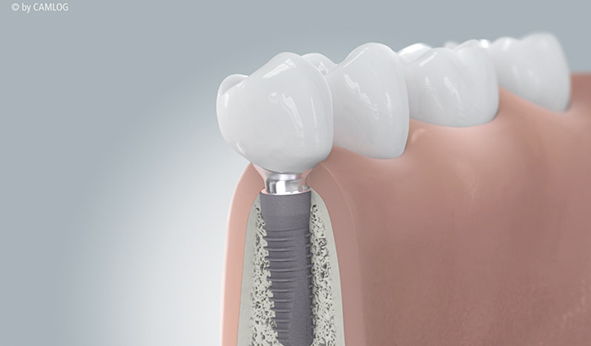 インプラント治療