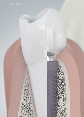 第二の永久歯～インプラント治療とは？～