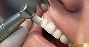 歯垢（プラーク）のチェックと除去