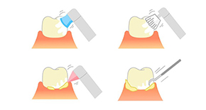 PMTC（プロフェッショナル・メカニカル・トゥース・クリーニング）